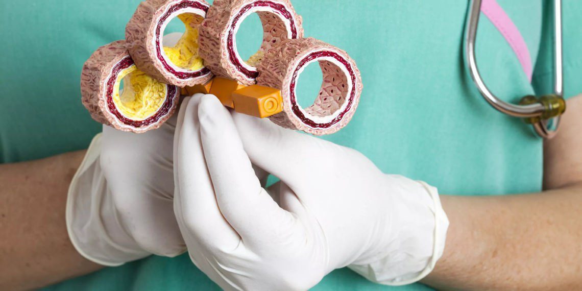 Вся правда о холестерине и атеросклерозе