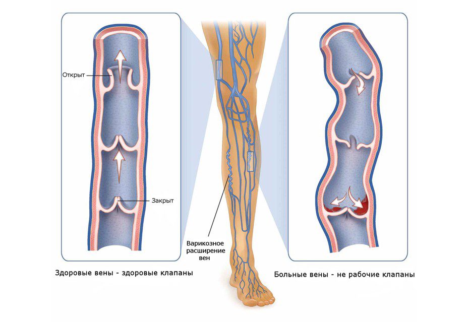 Варикозная болезнь – союз холода ваты и капхи